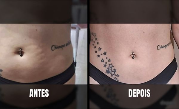 Antes e depois de tratamento de estética regenerativa facial