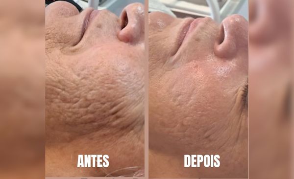Antes e depois de drenagem linfática corporal