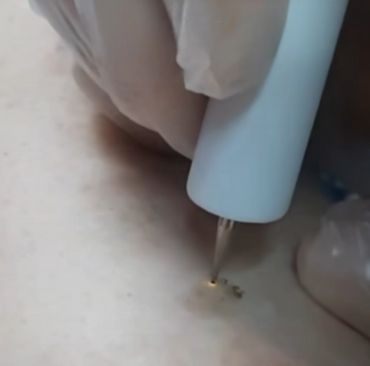 Foto de resultado de Jato de Plasma para manchas e flacidez