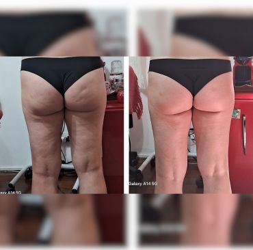 Drenagem Linfática para pós-operatório, gestantes e lipedema