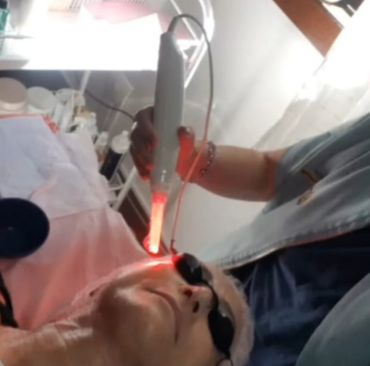 Foto de resultado de Jato de Plasma para manchas e flacidez