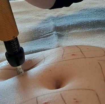 Foto de resultado de Jato de Plasma para manchas e flacidez