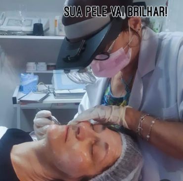 Foto de resultado de Jato de Plasma para manchas e flacidez