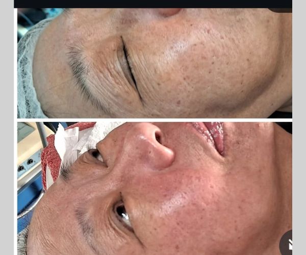 Intradermo Pressurizada e Drenagem Linfática - Tratamentos faciais e corporais