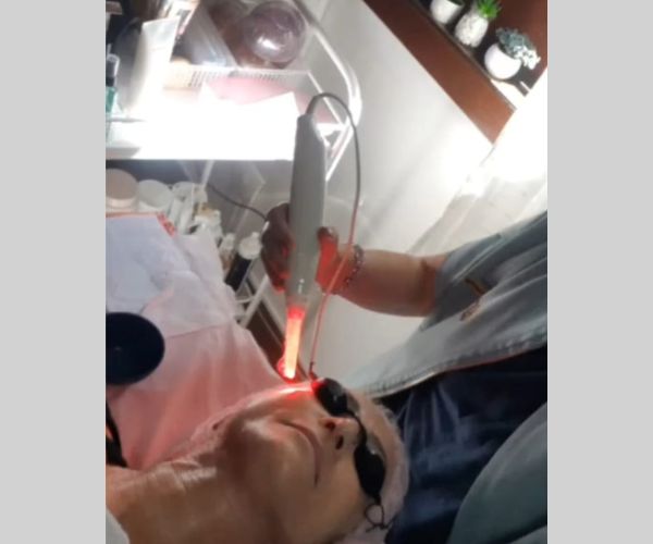 Laserterapia Facial - Tratamento de acne, manchas e estimulo de colágeno