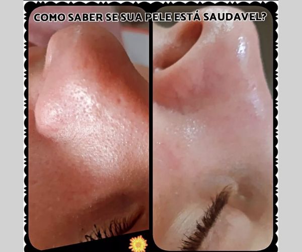 Dermaplaning - Remoção de pelos e células mortas