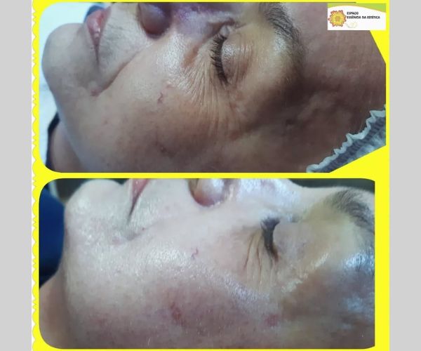 Peeling Plasmático - Sessão de revitalização da pele