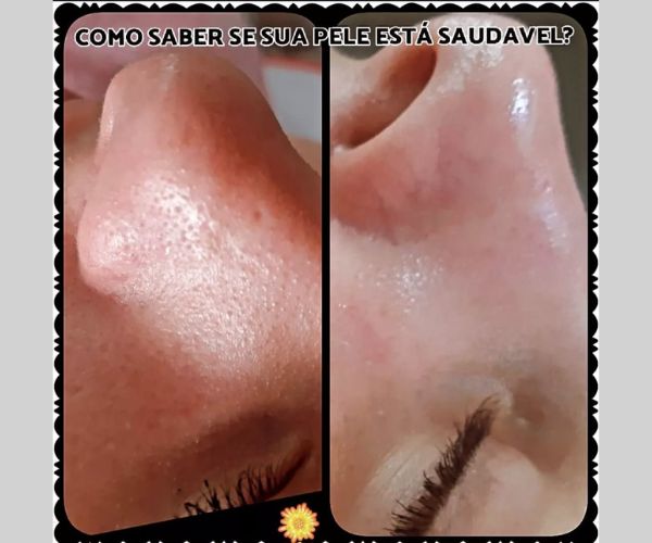 Peeling Químico - Renovação da pele