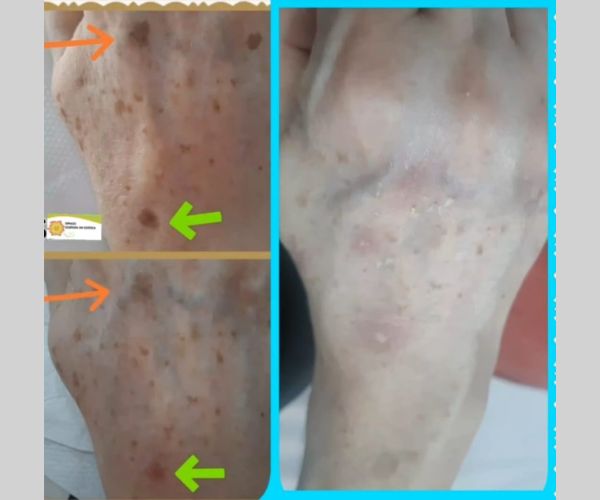 Radiofrequência Facial - Sessão de revitalização
