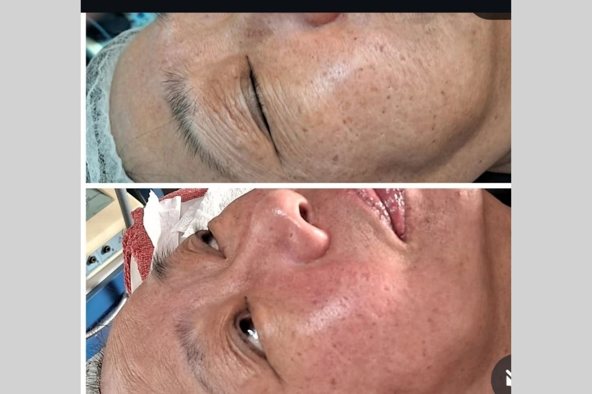 Intradermo Pressurizada e Drenagem Linfática - Essência da Estética