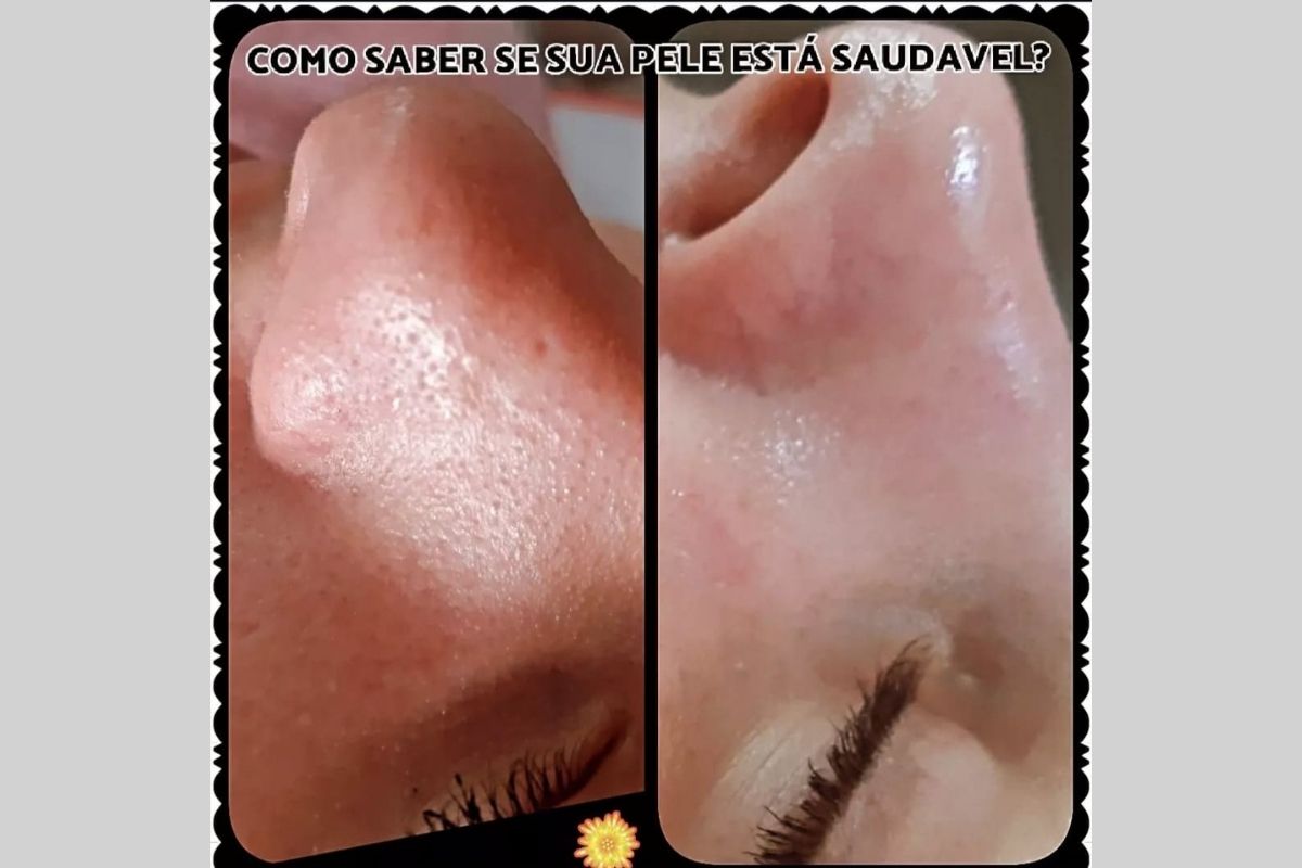 Dermaplaning - Essência da Estética