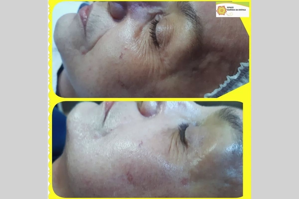 Peeling Plasmático - Essência da Estética