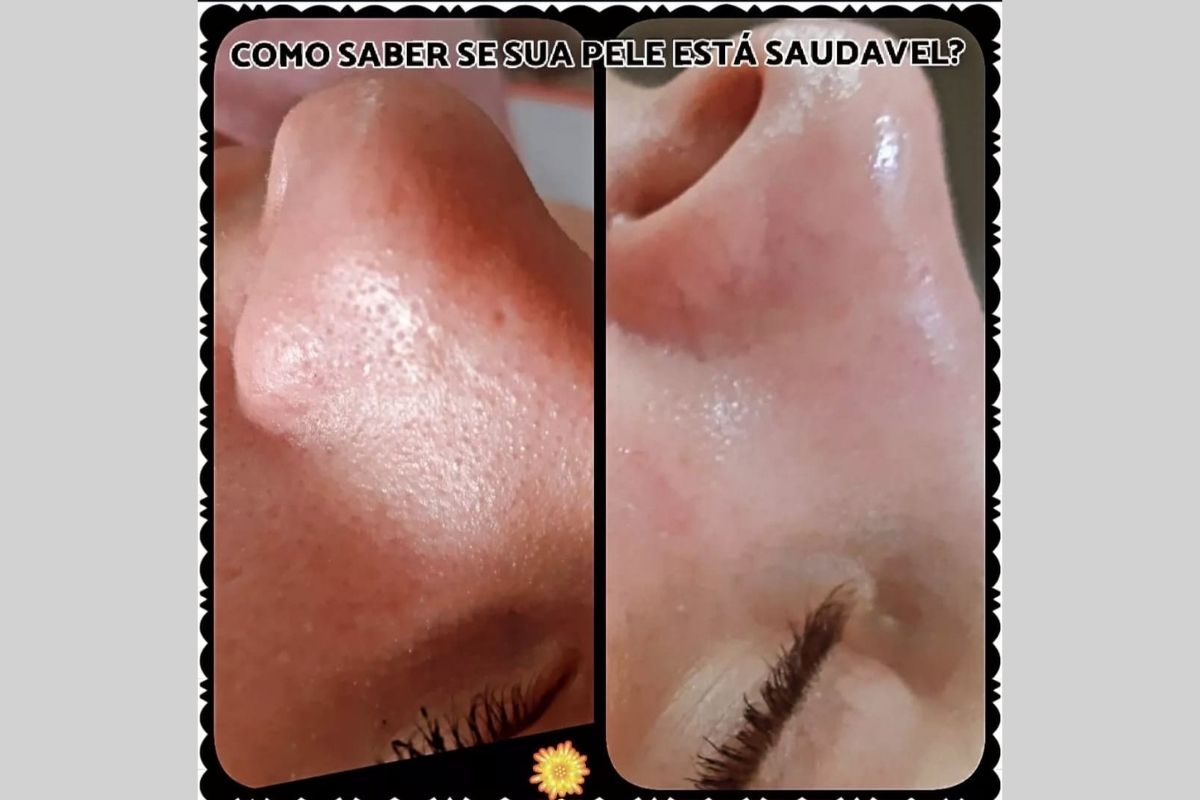 Peeling Químico - Essência da Estética