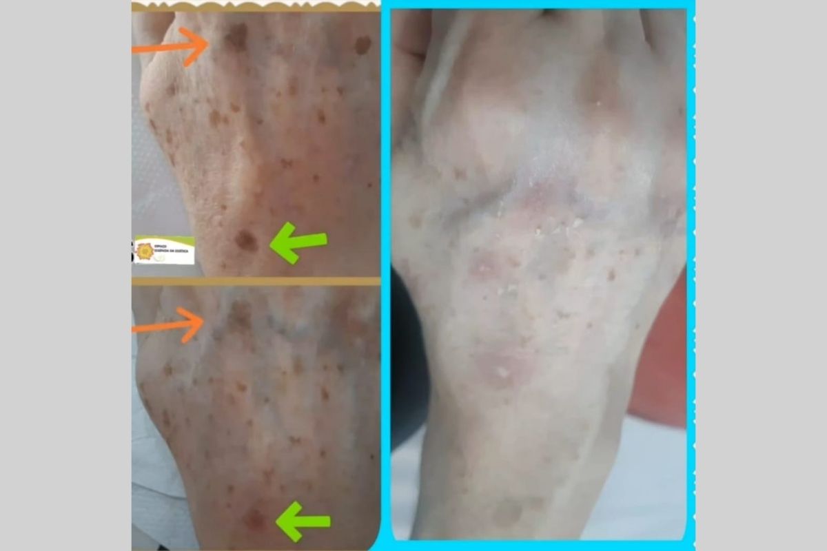Radiofrequência Facial - Essência da Estética