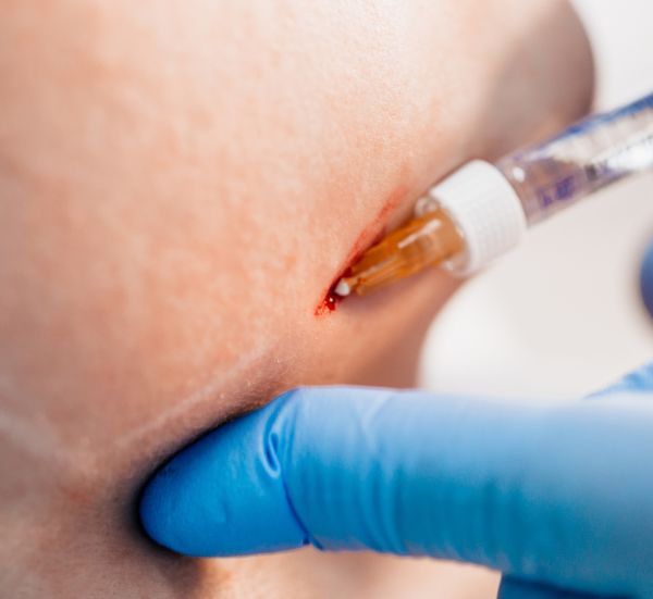 Intradermo terapia Corporal