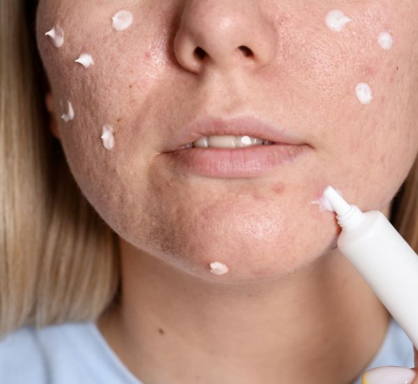 Tratamentos Pele acne