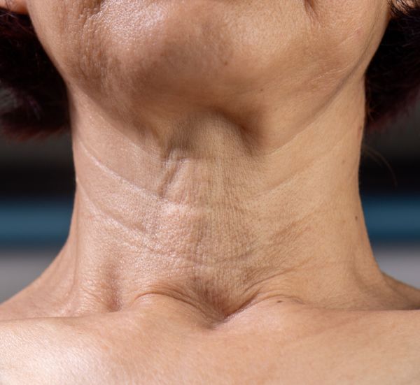 Tratamentos Flacidez Facial