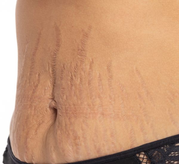 Tratamento de emagrecimento saudável e redução de medidas na Essência da Estética