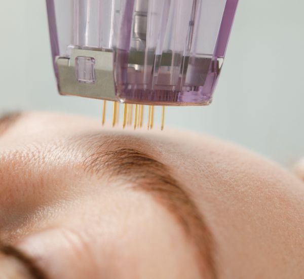 Microagulhamento/Dermapen Corporal
